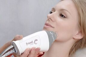 La esencia del procedimiento para el rejuvenecimiento fraccional de la piel del rostro.